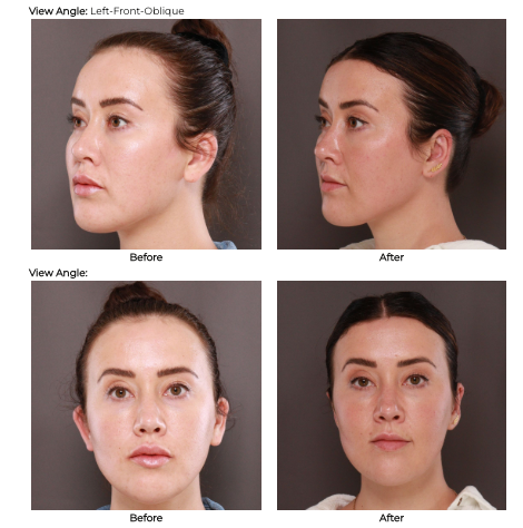 UFP Hair Restoration Forehead Reduction Surgery
